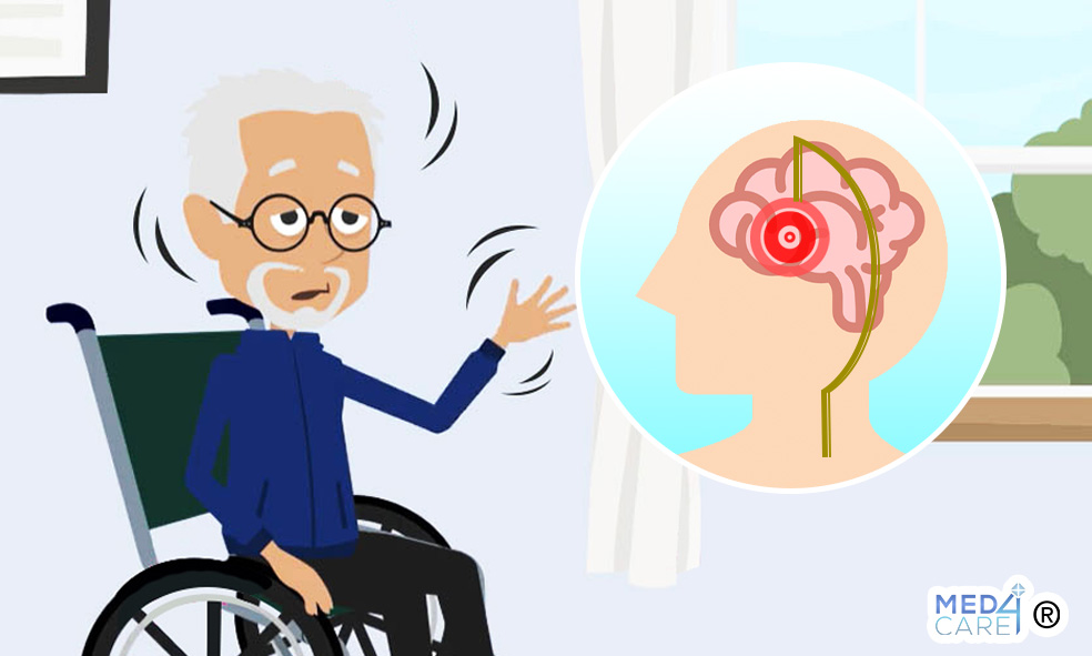 Stimolazione Cerebrale Profonda E Malattia Di Parkinson Quali Correlazioni Med Care