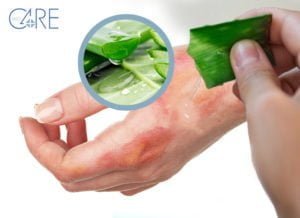 Scopri di più sull'articolo Aloe vera sulle ustioni: falso mito o verità?