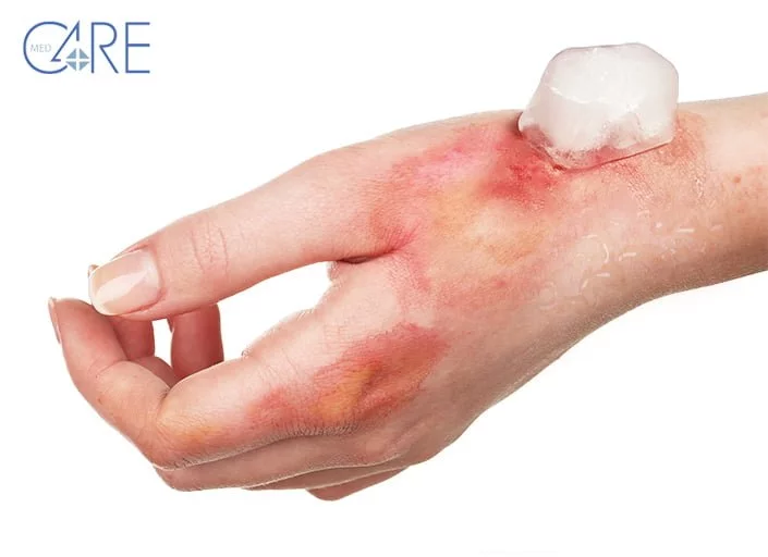 ghiaccio sulle ustioni