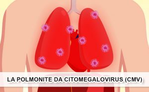 Scopri di più sull'articolo La polmonite da Citomegalovirus (CMV)