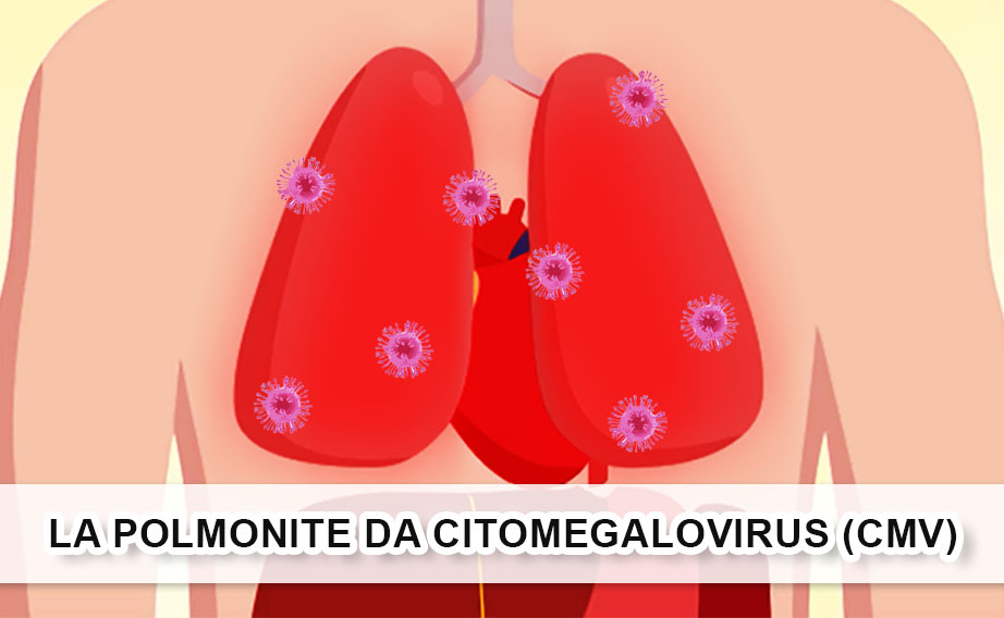 polmonite citomegalovirus cmv