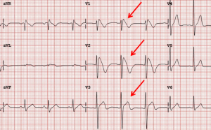 sindrome di brugada ecg