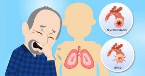 Scopri di più sull'articolo COVID-19 e malattie respiratorie croniche