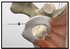 intervento di latarjet artroscopia bottoni lussazioni recidivanti della spalla