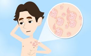 Scopri di più sull'articolo Psoriasi