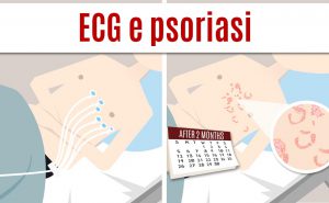 Scopri di più sull'articolo L’elettrocardiogramma (ECG) può esacerbare la psoriasi?