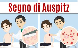 Segno di Auspitz che consente la diagnosi clinica della psoriasi a placche