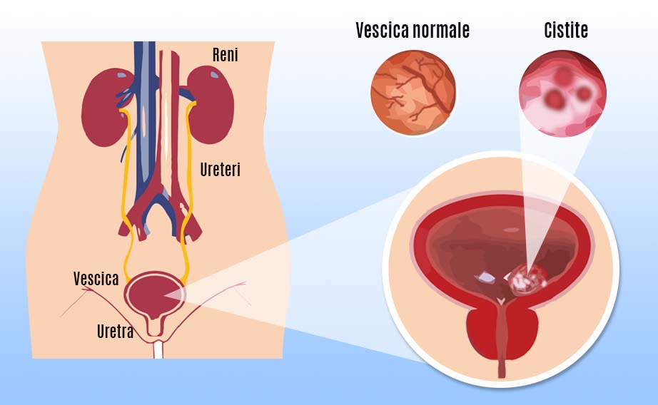 La cistite acuta provoca un'infiammazione della vescica