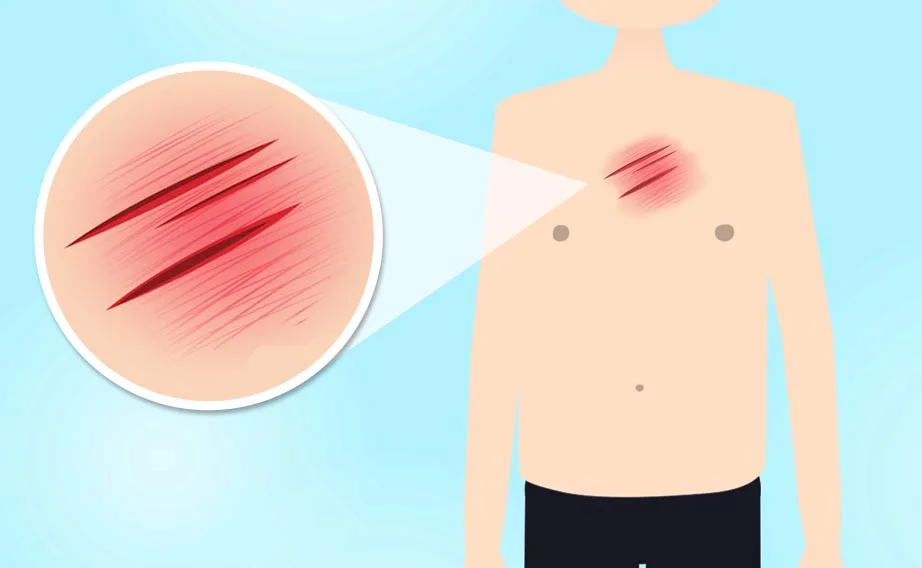 il fenomeno di Koebner interessa traumi o cicatrici chirurgiche in pazienti con malattie dermatologiche