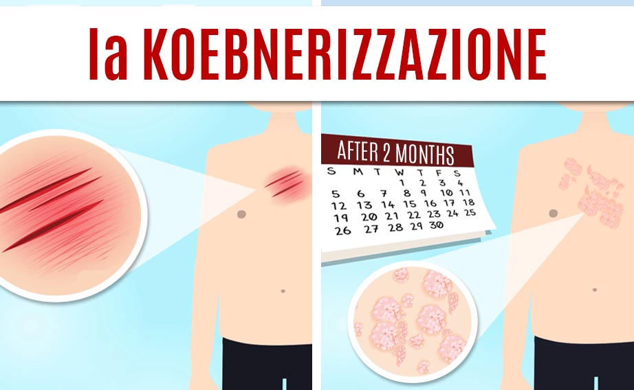 Il fenomeno di Koebner o Koebnerizzazione interessa alcune malattie dermatologiche tra cui la psoriasi