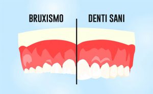 bruxismo denti