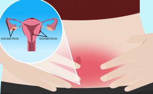 Scopri di più sull'articolo L’endometriosi: cos’è e come si cura