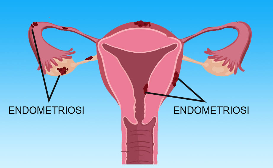 endometriosi