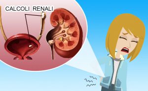 Scopri di più sull'articolo Calcoli renali – calcolosi delle vie urinarie