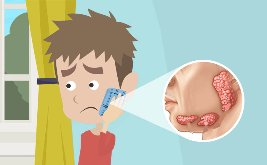 Sintomi della parotite: il gonfiore delle ghiandole salivari è un sintomo