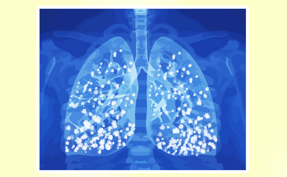 edema polmonare accumulo liquido negli alveoli