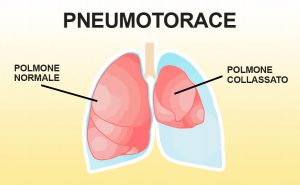 Scopri di più sull'articolo Lo pneumotorace