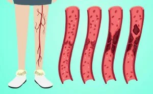 Scopri di più sull'articolo Tromboembolia venosa: cause, sintomi e cure