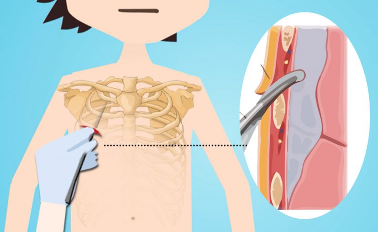 drenaggio percutaneo di emergenza con ago di pneumotorace