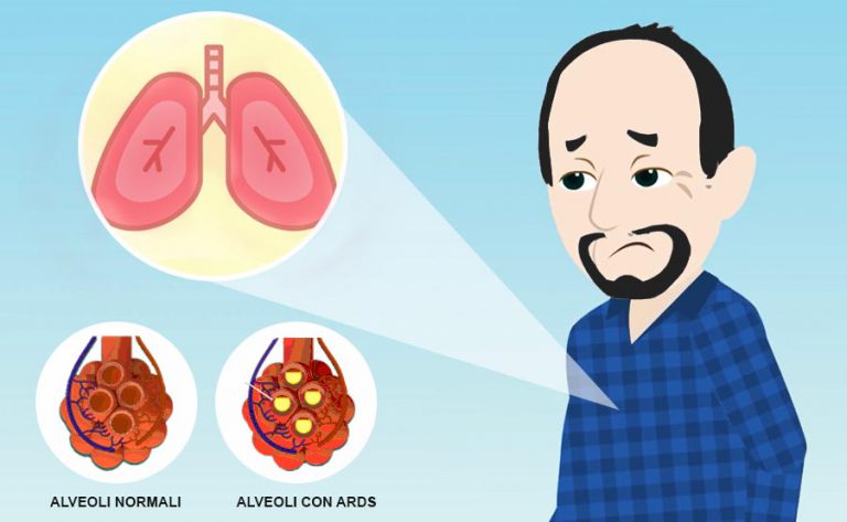 Sindrome da distress respiratorio acuto