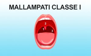 mallampati classe I