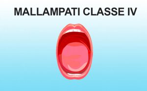 Mallampati classe IV