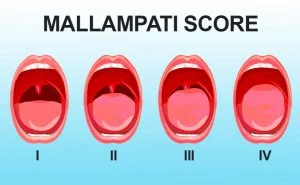 Scopri di più sull'articolo Criteri di Mallampati per l’intubazione difficile