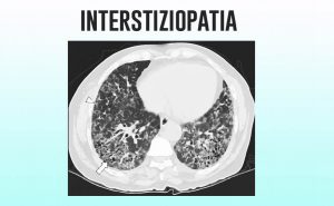 Scopri di più sull'articolo Interstiziopatia polmonare o fibrosi polmonare