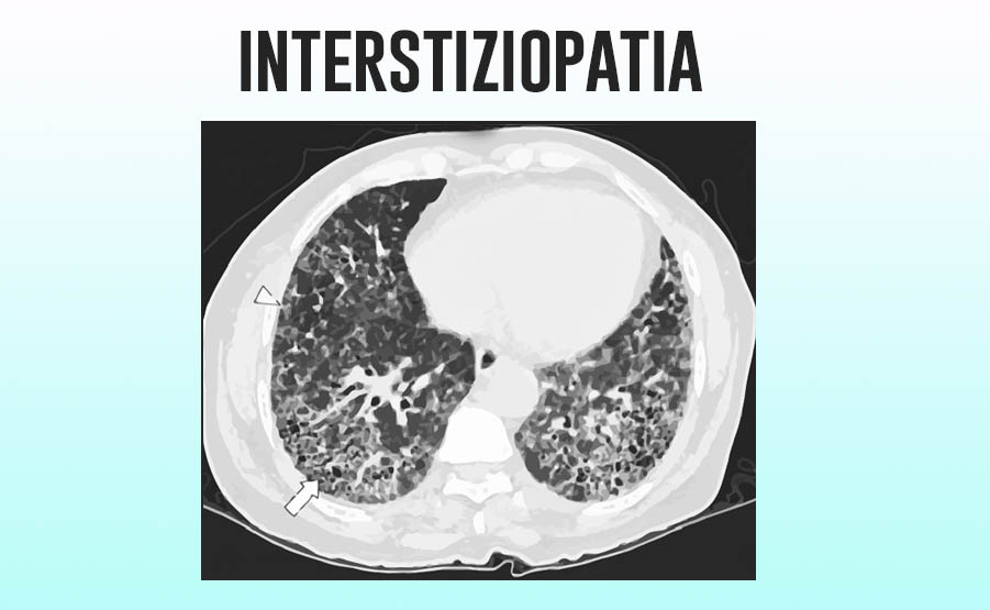 Interstiziopatia polmonare o fibrosi polmonare è una alterazione del tessuto polmonare, che può dipendere da molte cause