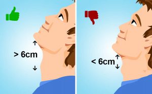 distanza tiromentoniera criterio intubazione difficile