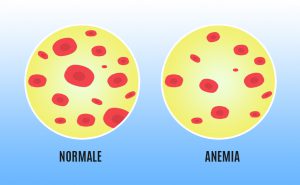 Scopri di più sull'articolo Anemia