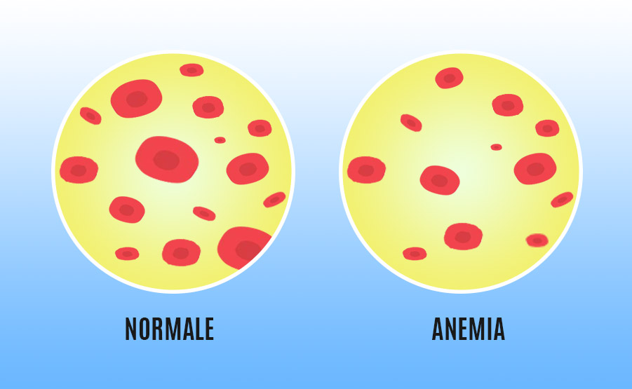 Anemia: è un abbassamento dei livelli di emoglobina nel sangue