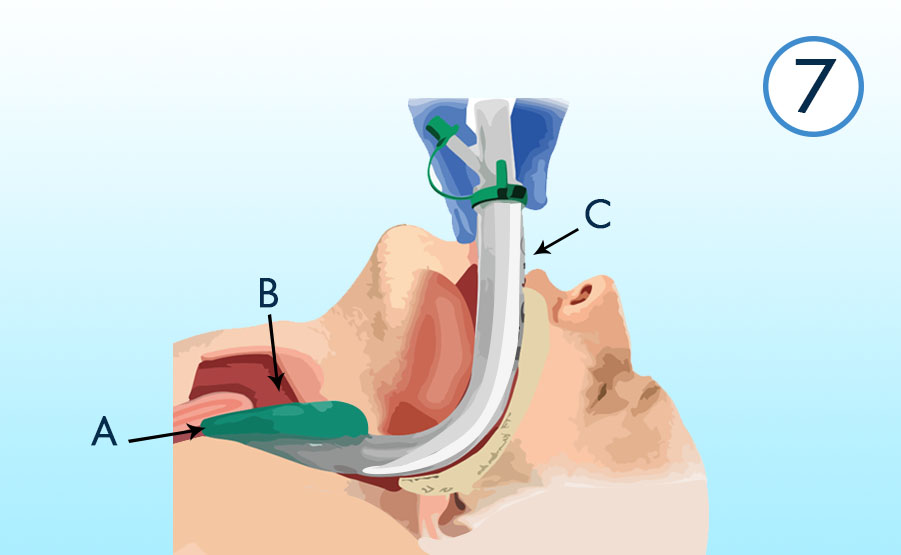 maschera laringea i-gel posizionamento in faringe