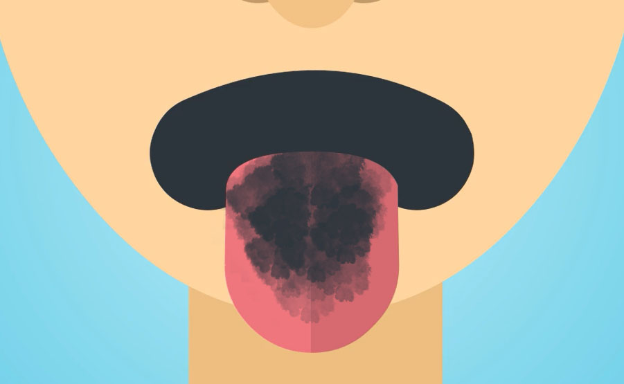 La lingua nera villosa è una condizione orale temporanea e innocua che conferisce alla lingua un aspetto scuro e peloso.