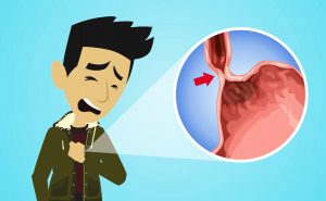 Scopri di più sull'articolo Acalasia esofagea: il disturbo della motilità dell’esofago