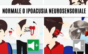 test di rinne positivo: normale o ipoacusia neurosensoriale