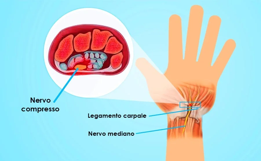 La sindrome del tunnel carpale si verifica quando il nervo mediano, che va dall'avambraccio al palmo della mano, viene premuto o schiacciato al polso.