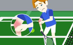 Scopri di più sull'articolo Il gomito del tennista – Epicondilite