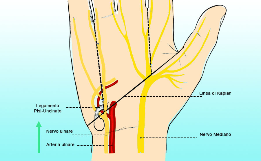 Sindrome del canale di Guyon: nervo ulnare al polso