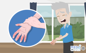 Scopri di più sull'articolo L’artrosi delle mani