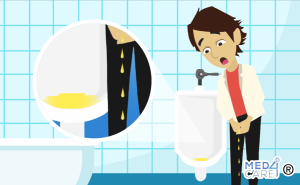 Scopri di più sull'articolo Gocciolamento post-minzionale: quando l’urina cade a gocce
