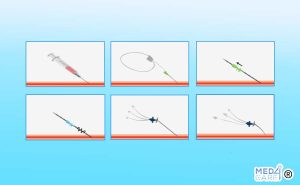 Scopri di più sull'articolo Tecnica di Seldinger: l’uso del filo-guida per le procedure