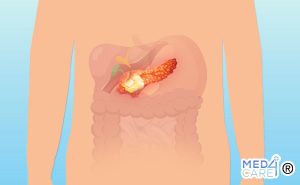 Scopri di più sull'articolo I tumori neuroendocrini del pancreas (PNET)