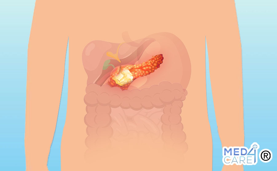 Tumori neuroendocrini del pancreas