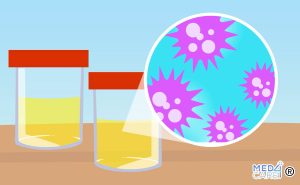 Scopri di più sull'articolo Leucocituria: quando nelle urine ci sono i globuli bianchi