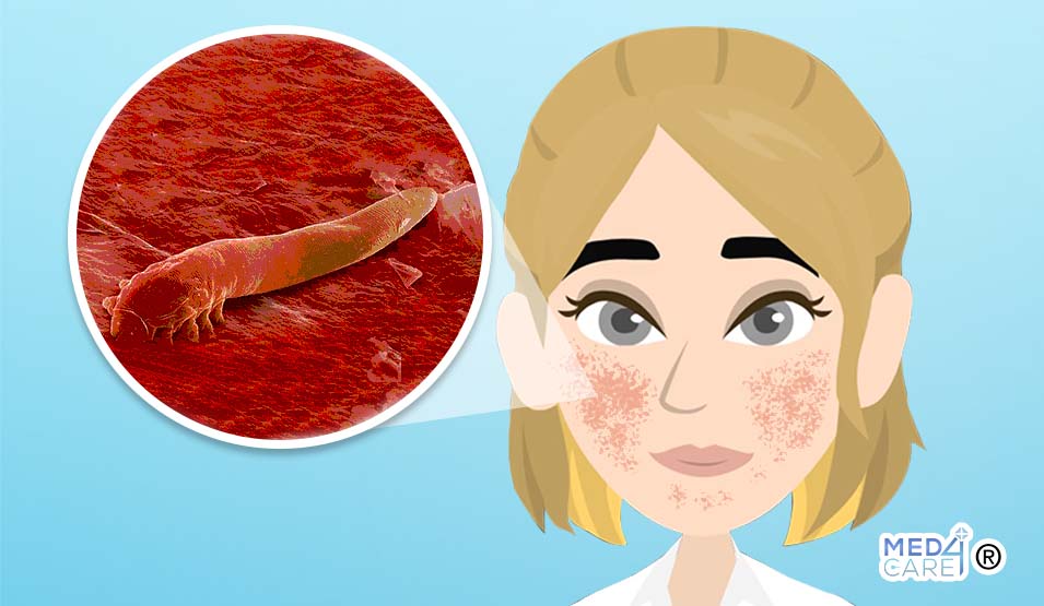 Rosacea: il demodex folliculorum può essere una causa