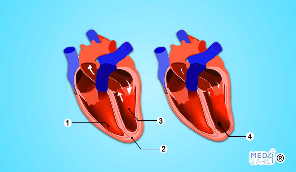 Scompenso cardiaco