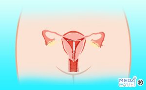 Scopri di più sull'articolo Dispositivi intrauterini o IUD