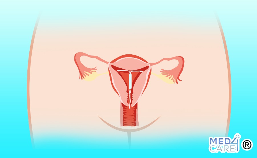 Dispositivi intrauterini contraccettivi