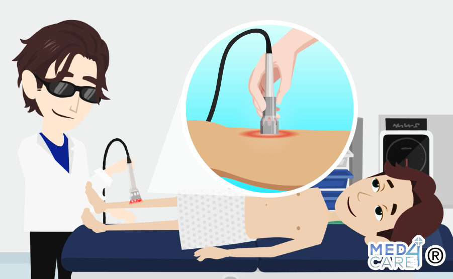 Laserterapia in fisioterapia